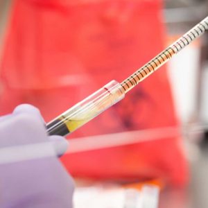 Un nuevo análisis de sangre detecta qué tan grave será la infección por covid-19