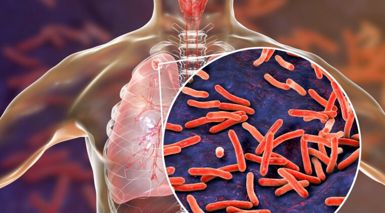 Día mundial de la Tuberculosis: qué es y cómo se trata