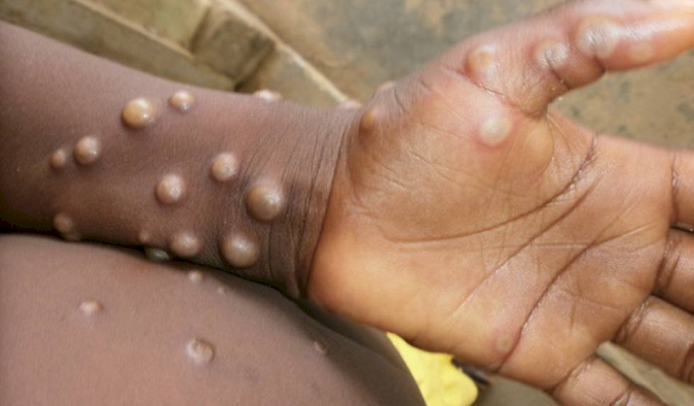 O que é a varíola do macaco, doença que deixa países europeus em alerta