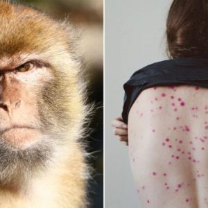 Qué dicen los expertos sobre la viruela del mono