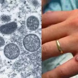 Mato Grosso do Sul tem primeiro caso suspeito da varíola dos macacos￼