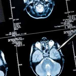 Nueva técnica permite extirpar tumor cerebral preservando un área del lenguaje