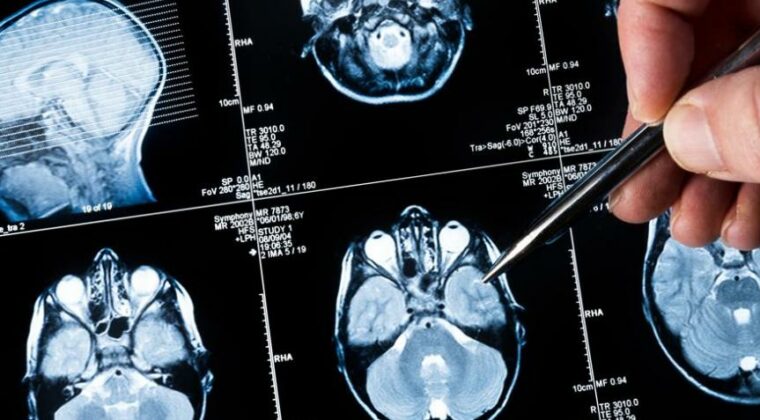 Nueva técnica permite extirpar tumor cerebral preservando un área del lenguaje
