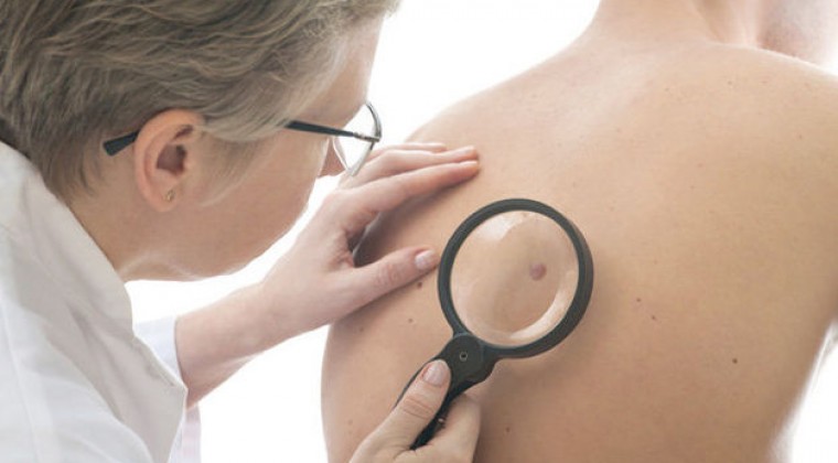 Altas temperaturas: advierten sobre cánceres en la piel