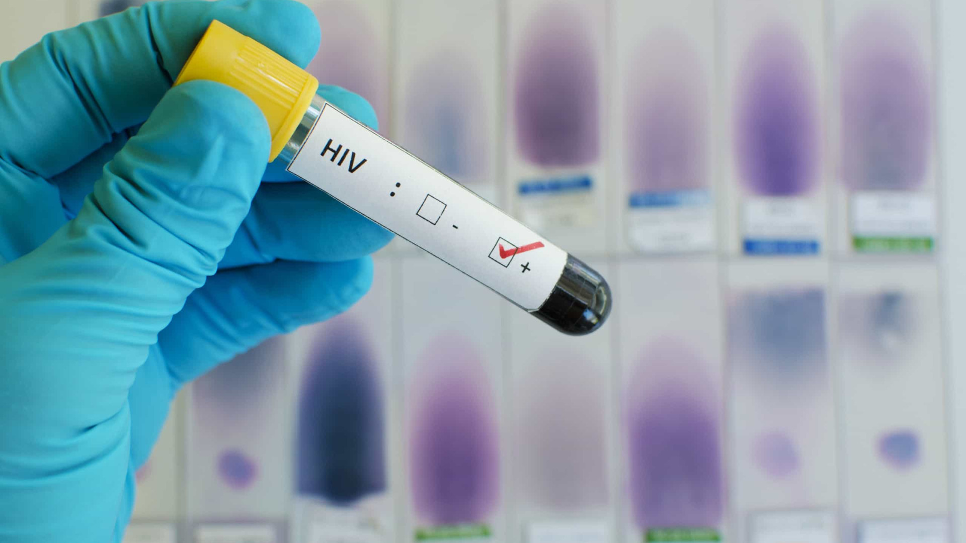 Novo paciente com HIV é curado após transplante de células-tronco, diz estudo