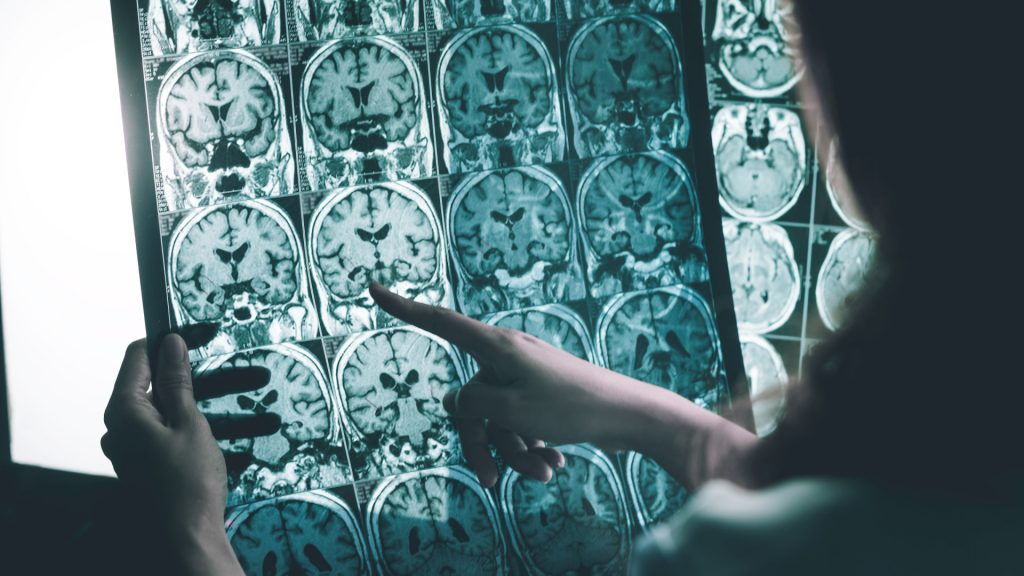 Droga em teste contra Alzheimer reduz em até 60% a progressão da doença, revela estudo