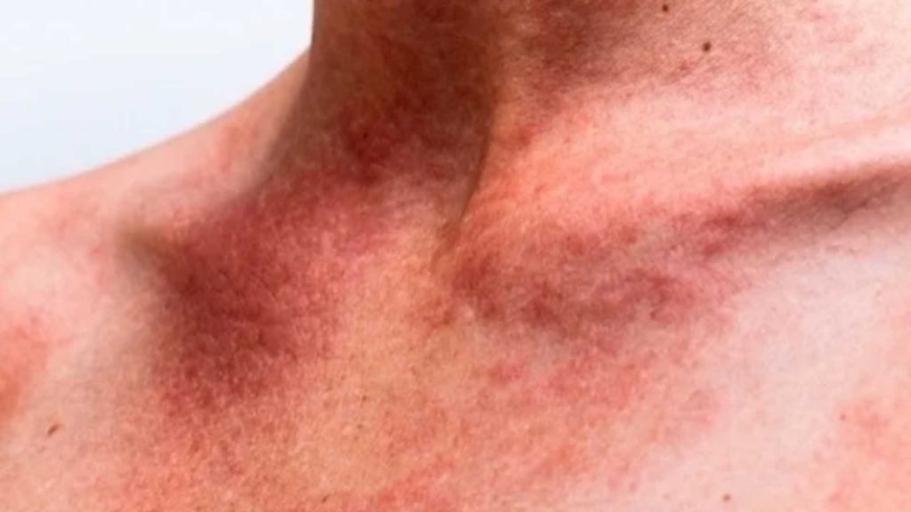 Calor de ‘derreter’ agrava assaduras e pode desencadear problemas de pele