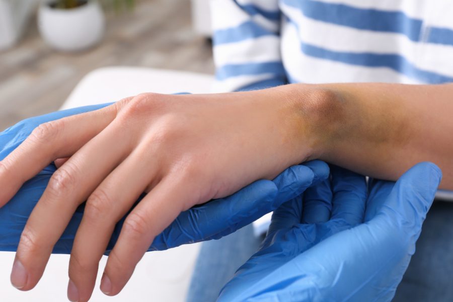 Médico sensibiliza: Leucemia pode se ver nas mãos; entenda